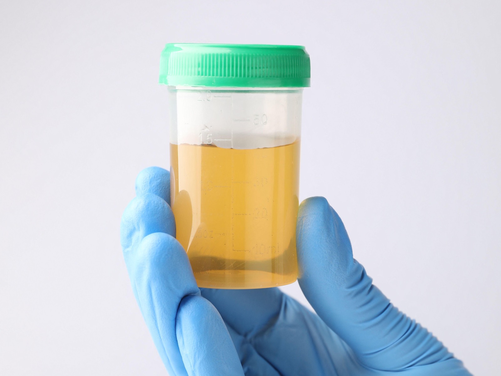 Urine sample in a specimen pot